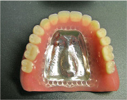 コバルト義歯